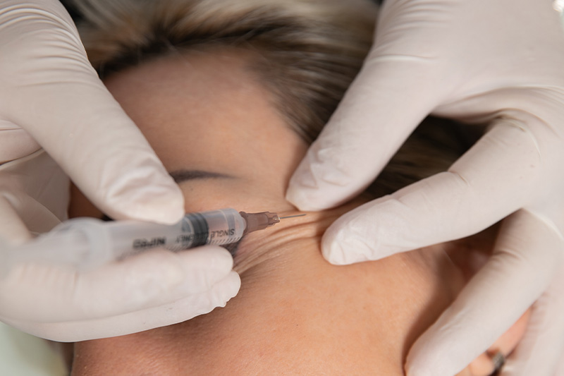 Botox tretman - Brzo i efikasno uklanjanje bora