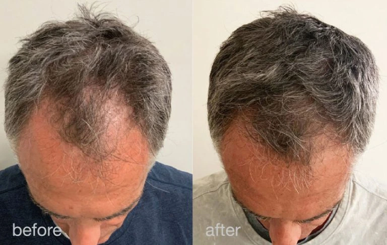 Laserski tretman za obnovu i rast kose – HAIRestart