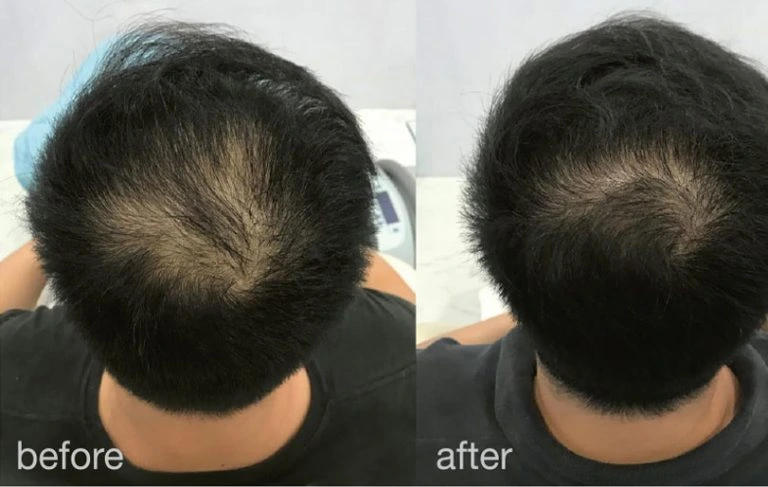 Laserski tretman za obnovu i rast kose – HAIRestart