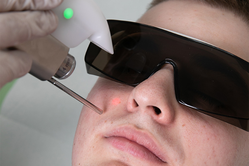 Uklanjanje hiperpigmentacije - laserska terapija