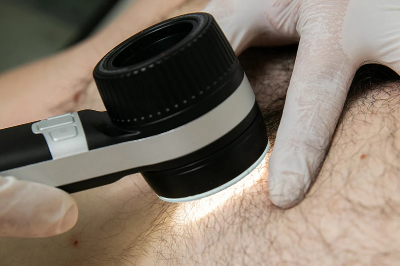 Dermatološki pregledi Pregled mladeža dermatoskopom