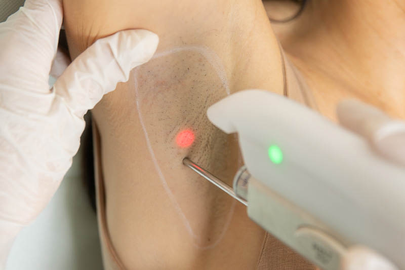 Lečenje prekomernog znojenja