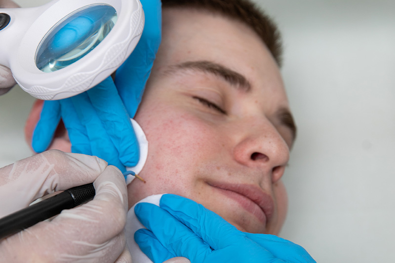 Uklanjanje benignih promena RF nožem