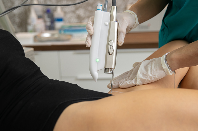 Strije - Terapija Fotona Laserom - LineLase