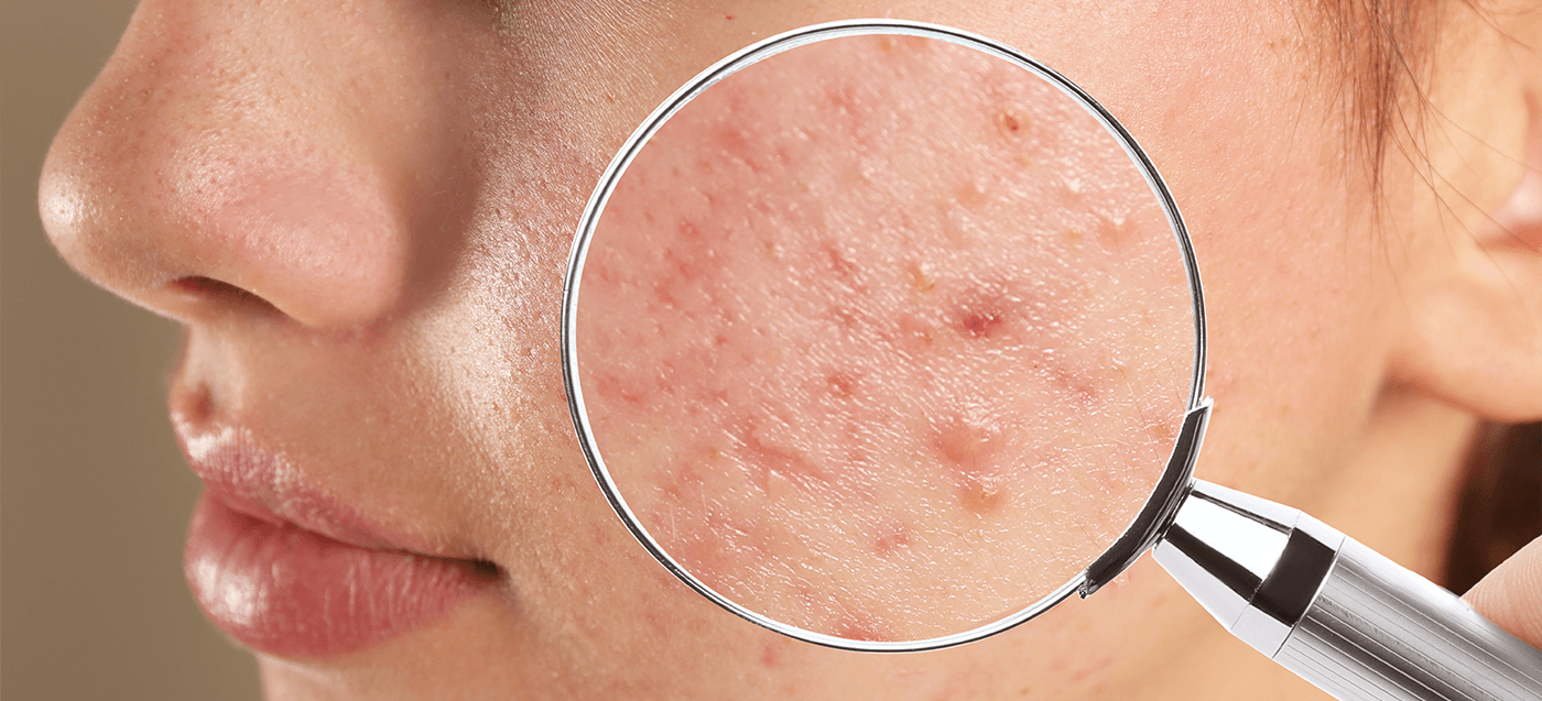 Laser u dermatologiji