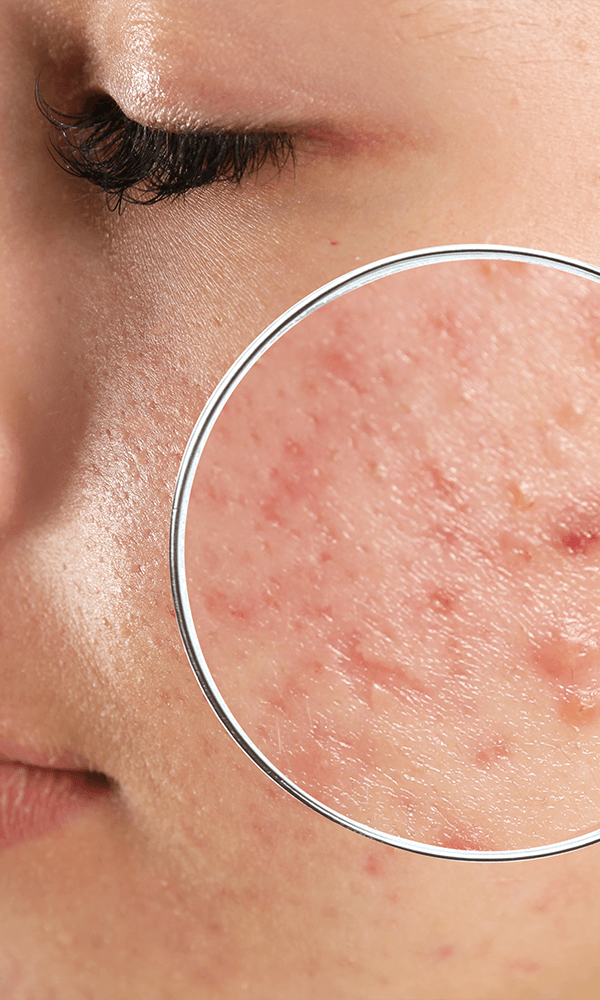 Laser u dermatologiji